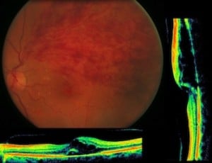 trombosi venosa retinica